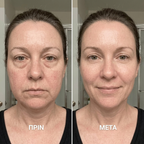 Rituéa I Βούρτσα λεμφικού μασάζ